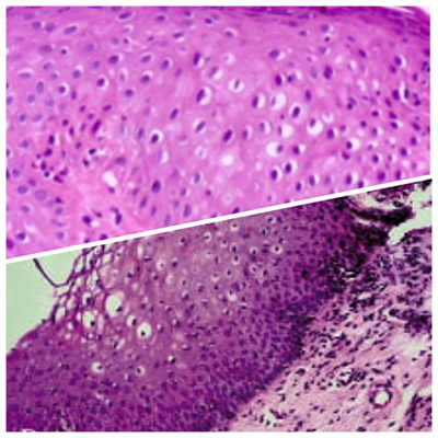 Micropapilomatosis Vulvar