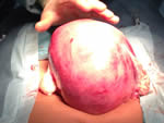 Giant fibroid