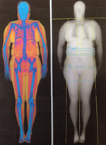 Densitometría osea de una persona obesa