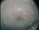 Cuello uterino expuesto en prueba de Papanicolau