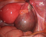 Functional Ovarian Tumor