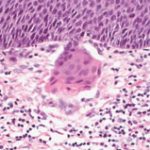 Cancer microinvasor | Virus del papiloma humano