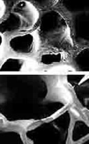 Imagen referencial de la osteoporosis