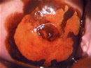 Cuello uterino con cambios por VPH