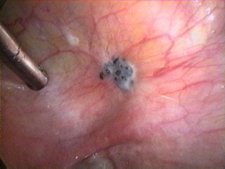 Implante endometriósico (visión laparoscópica), antes de fulgurar