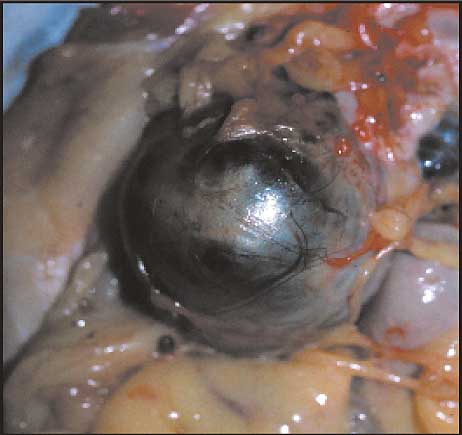 Quiste de chocolate: endometrioma ovárico de color marrón-negro