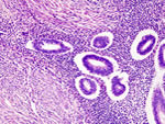 Anatomía patológica: glándulas endometriales infiltrando el músculo uterino