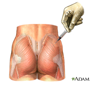 Aplicación intramuscular