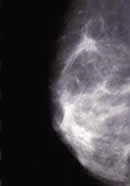 Cáncer - patrón estrella en expansión
