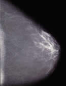 Mamografía normal cráneo-caudal
