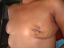 Tumor detrás del pezón