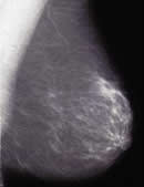 Mamografía normal lateral