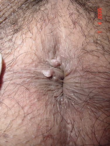 Condiloma anal, lesión pequeña