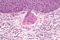 Cáncer microinvasor asociado a VPH