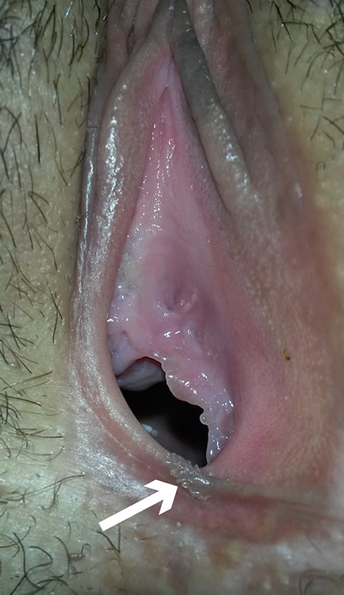 Condilomas filiformes por VPH