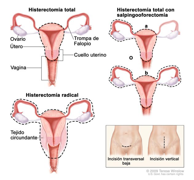 Histerectomía