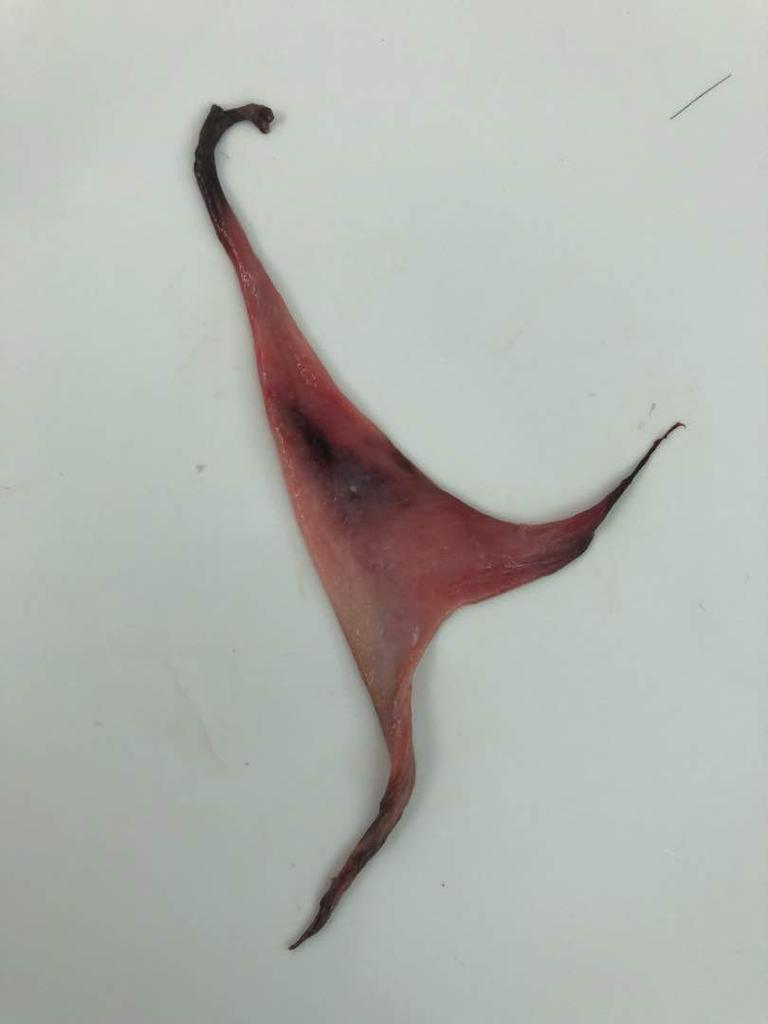 Dismenorrea membranosa